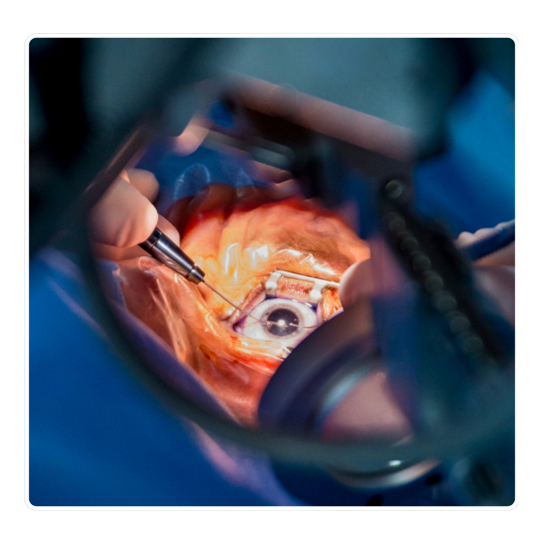 cataract surgery support